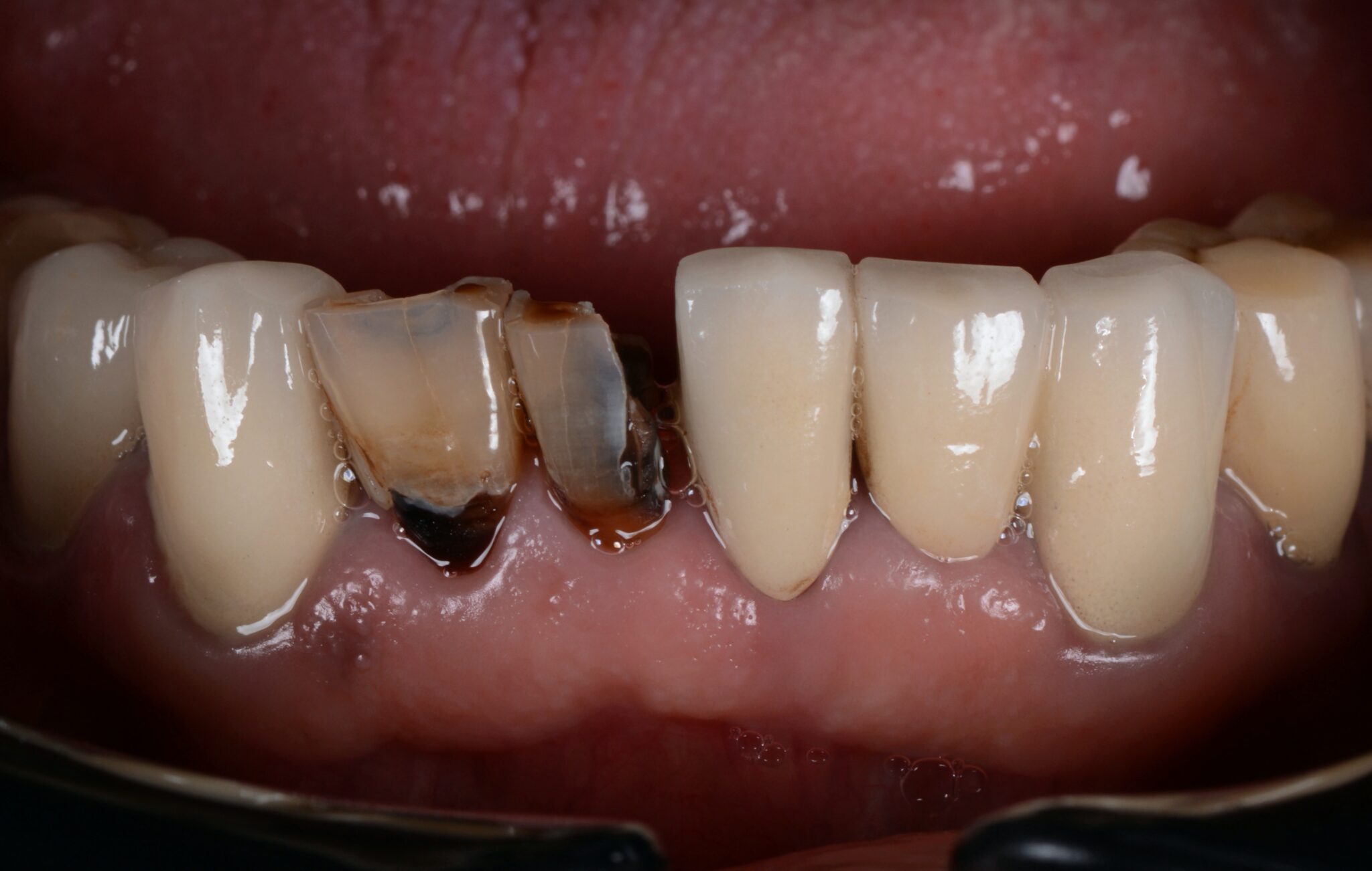 Elim Dental dentist in Mount Kisco, NY DR. JIN SUB OH, DMD, MS Schema yoast
