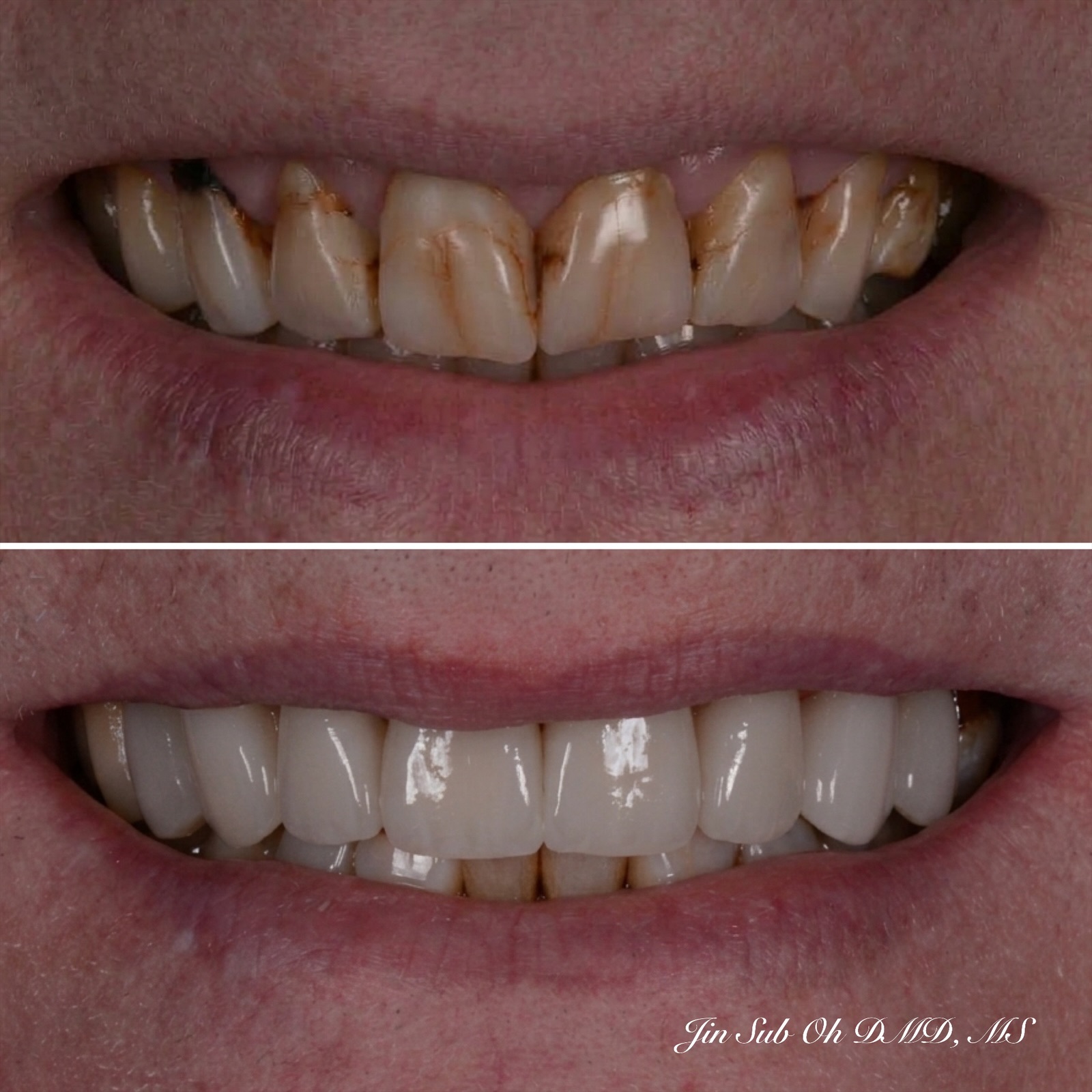 Complete smile makeover featuring cosmetic dentistry and veneers at Elim Dental.