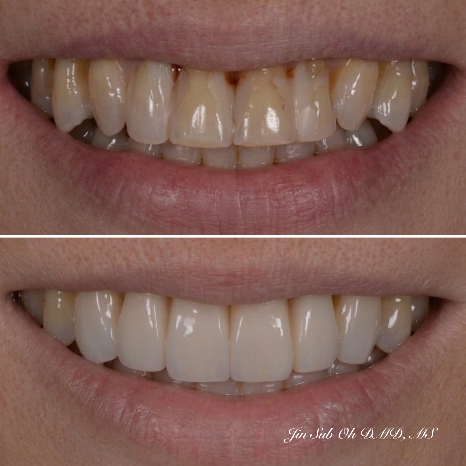 Before and after porcelain veneers to correct chipped and discolored teeth at Elim Dental in Mt. Kisco.