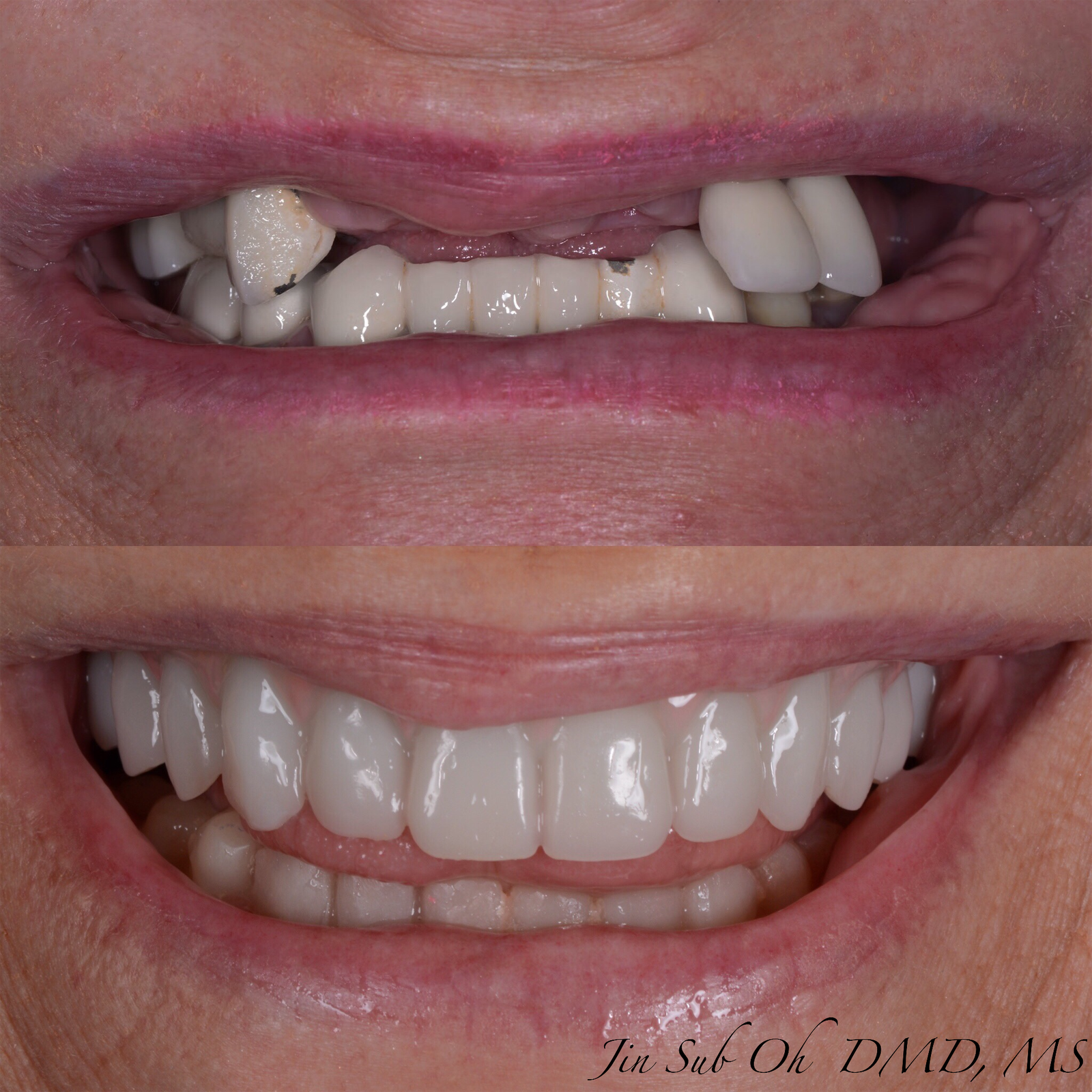 Before and after transformation of a patient who received All-on-X dental implants at Elim Dental in Westchester.