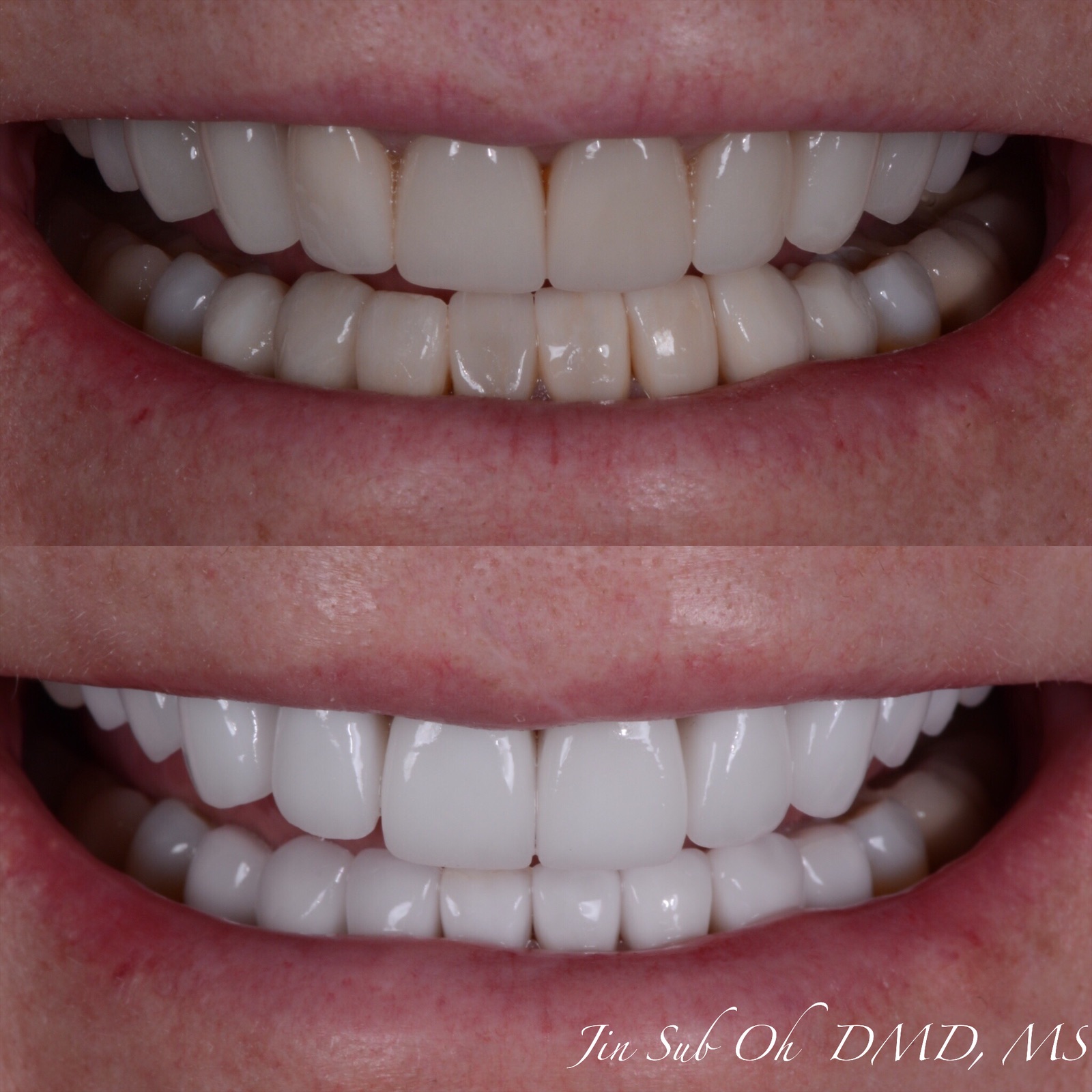 Before and after smile transformation replacing old, aged porcelain restorations with new custom cosmetic veneers and crowns in Mt. Kisco.