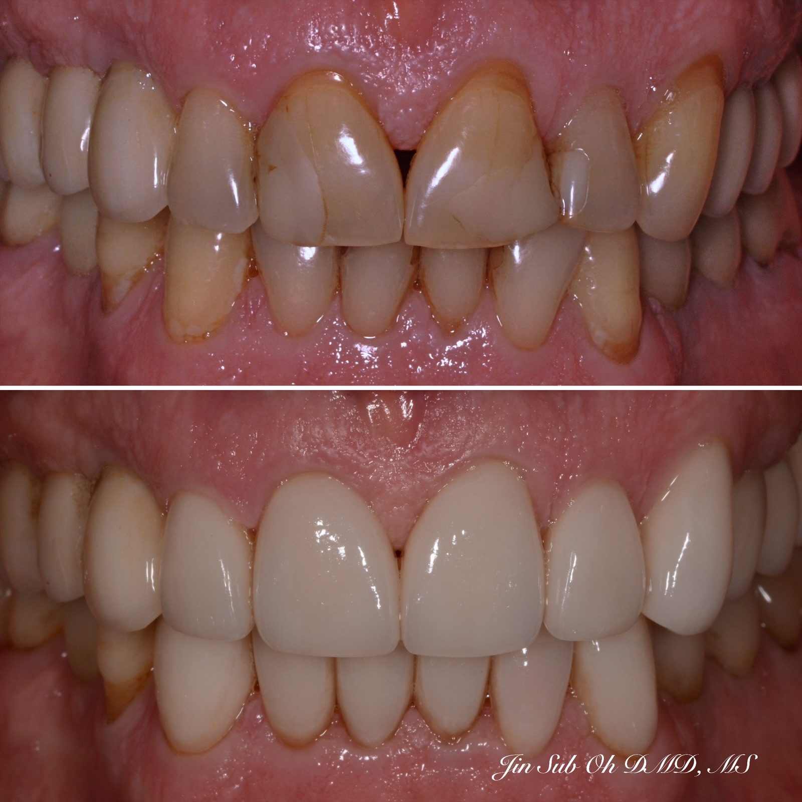 Before and after transformation of a patient who received custom dental crowns and porcelain veneers in Mt. Kisco.