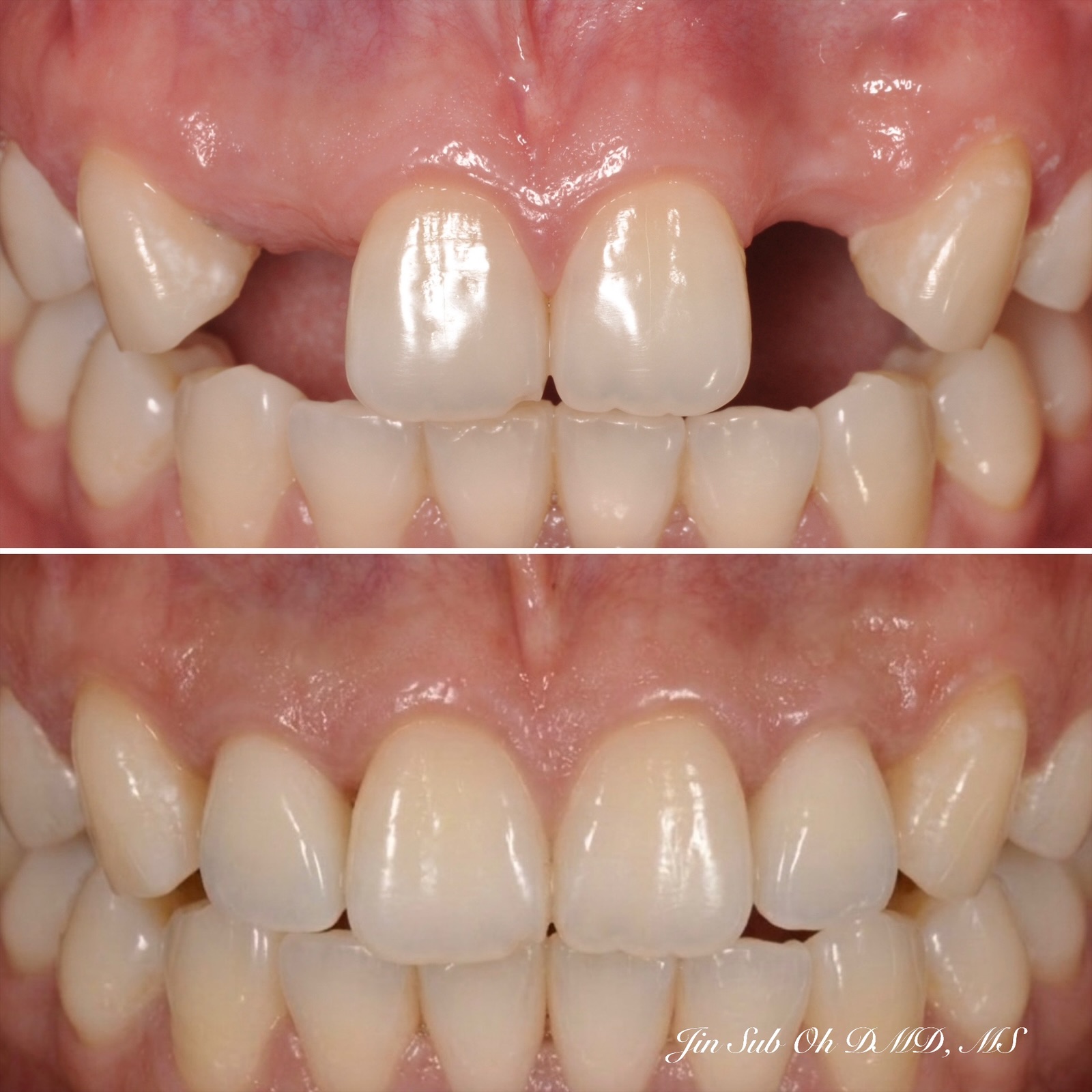 Before and after results of a patient receiving custom dental implants to replace missing lateral incisors at a Mt. Kisco dental practice.