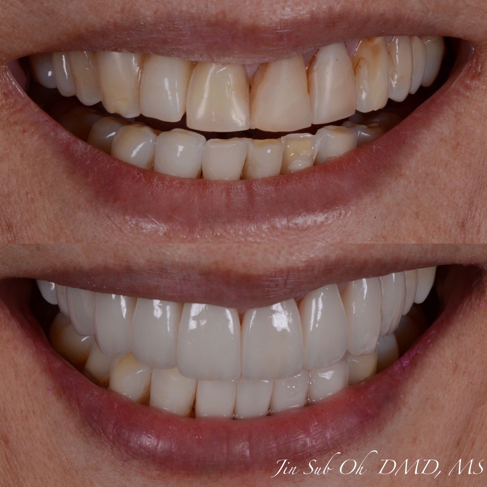 Before and after smile rejuvenation with cosmetic porcelain veneers in Westchester, NY.