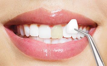 Dental Veneers