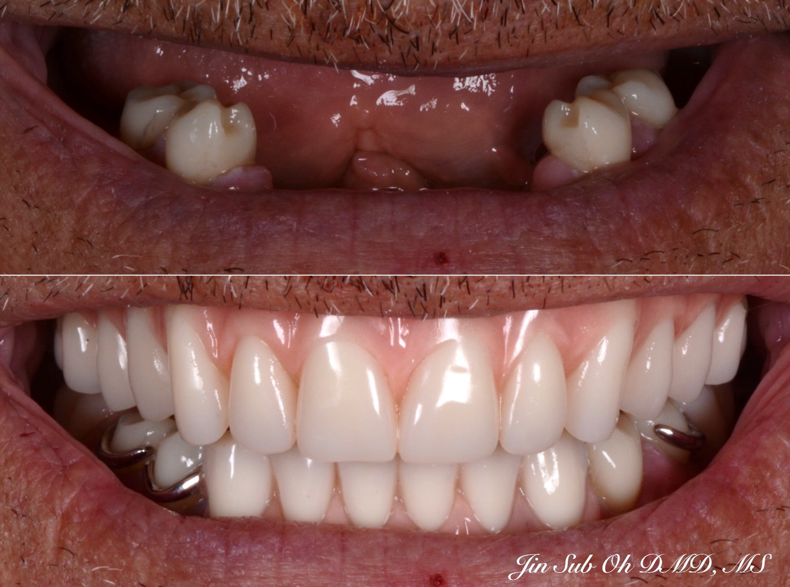 Full Mouth Rehabilitation